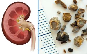 Böbrek ve Üreter Taşı Oluşma Nedenleri